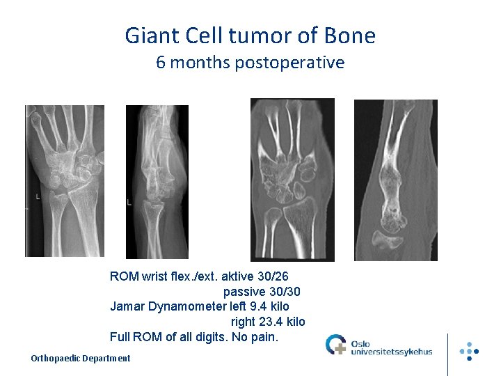 Giant Cell tumor of Bone 6 months postoperative ROM wrist flex. /ext. aktive 30/26