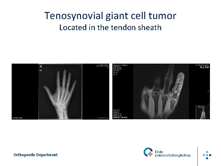 Tenosynovial giant cell tumor Located in the tendon sheath Orthopaedic Department 