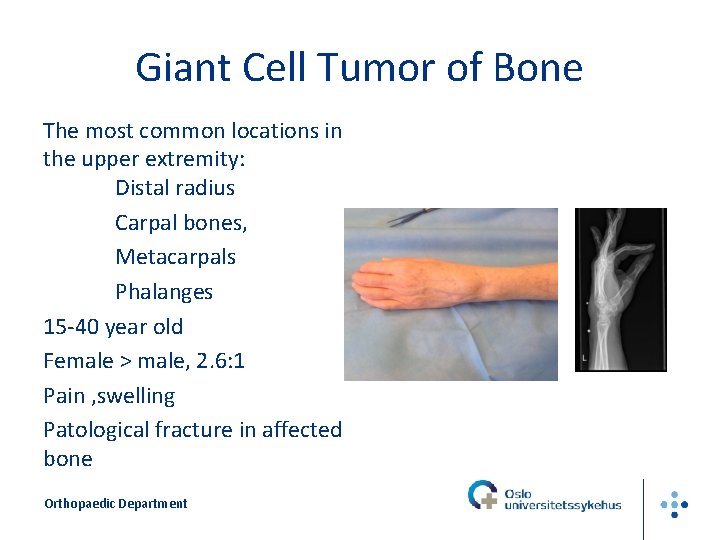 Giant Cell Tumor of Bone The most common locations in the upper extremity: Distal