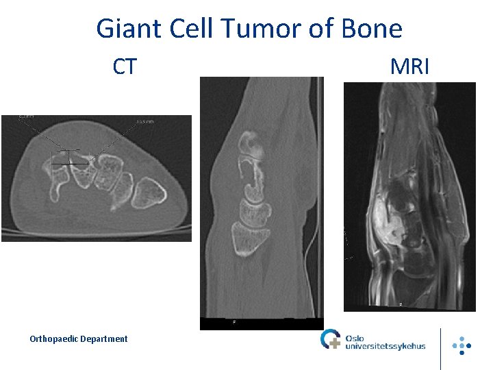 Giant Cell Tumor of Bone CT Orthopaedic Department MRI 