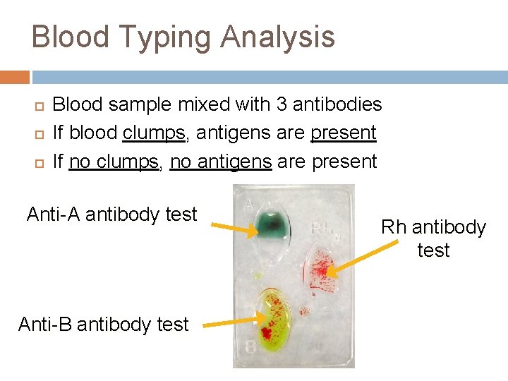 Blood Typing Analysis Blood sample mixed with 3 antibodies If blood clumps, antigens are