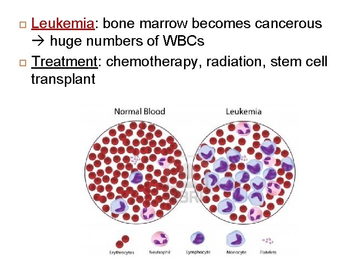  Leukemia: bone marrow becomes cancerous huge numbers of WBCs Treatment: chemotherapy, radiation, stem