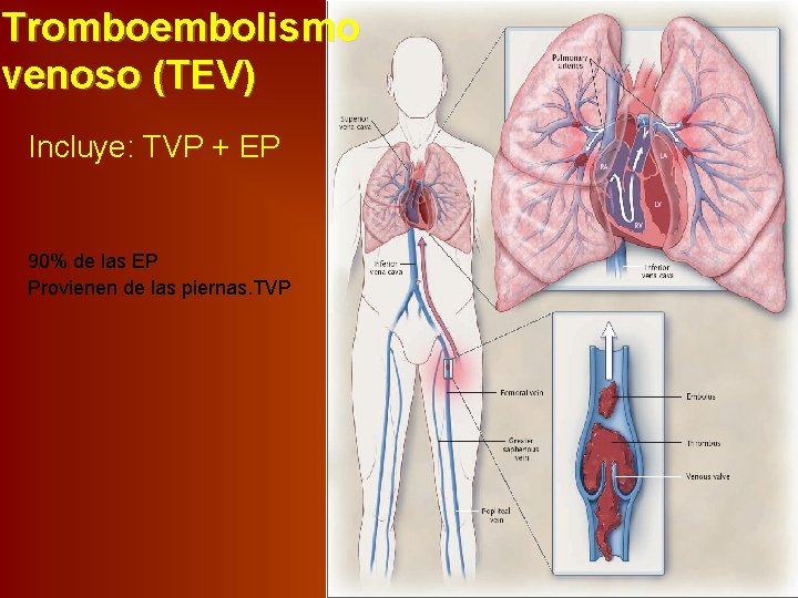 Tromboembolismo venoso (TEV) Incluye: TVP + EP 90% de las EP Provienen de las