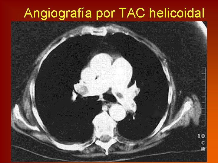 Angiografía por TAC helicoidal 