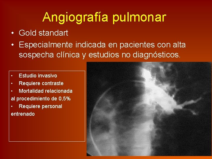 Angiografía pulmonar • Gold standart • Especialmente indicada en pacientes con alta sospecha clínica