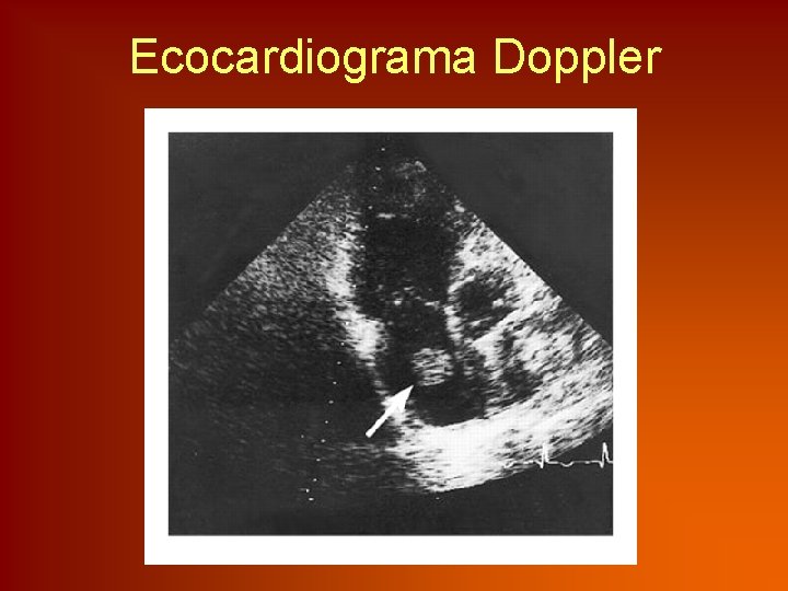 Ecocardiograma Doppler 