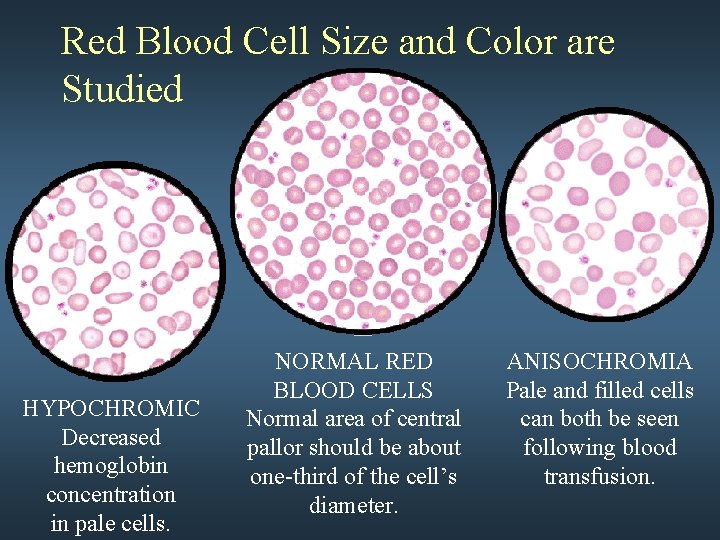 Red Blood Cell Size and Color are Studied HYPOCHROMIC Decreased hemoglobin concentration in pale