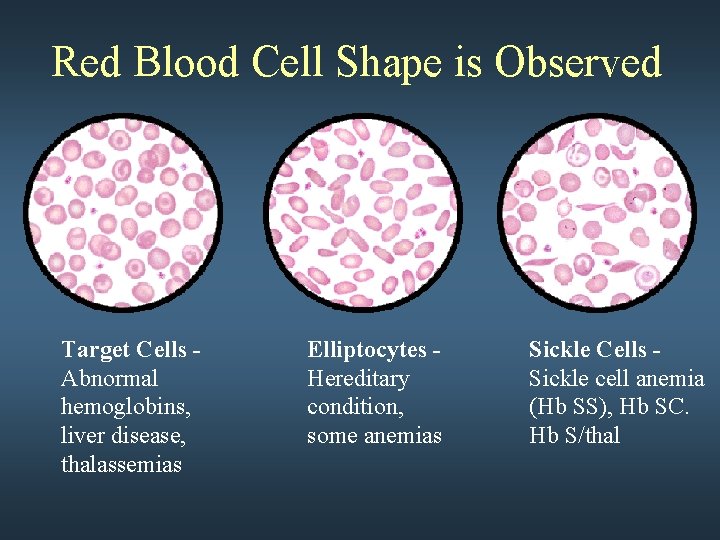 Red Blood Cell Shape is Observed Target Cells Abnormal hemoglobins, liver disease, thalassemias Elliptocytes