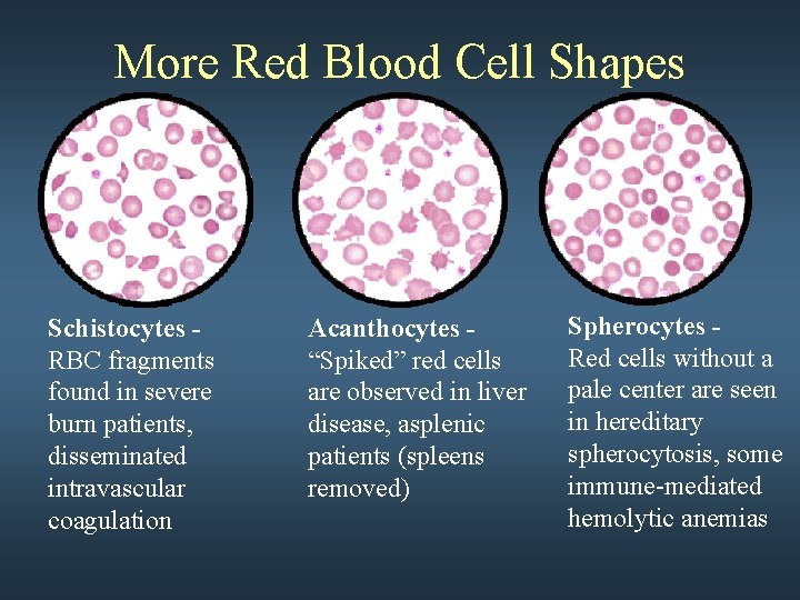 More Red Blood Cell Shapes Schistocytes RBC fragments found in severe burn patients, disseminated