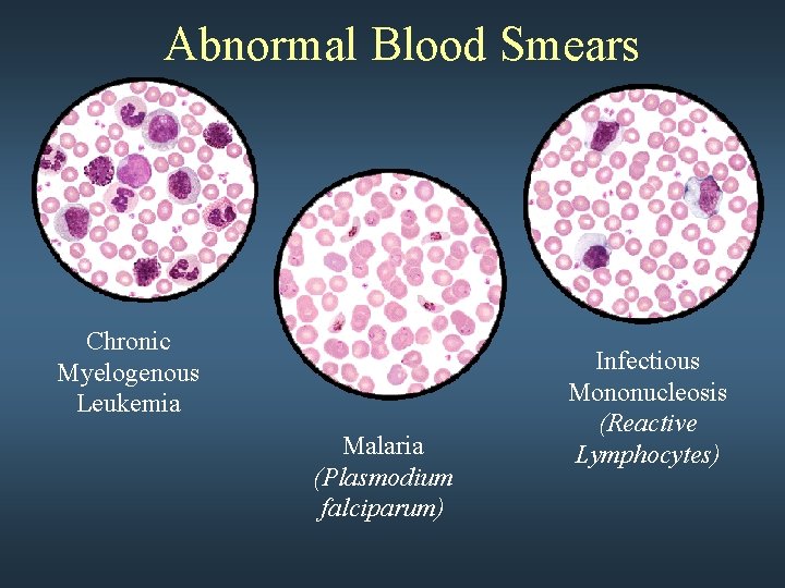 Abnormal Blood Smears Chronic Myelogenous Leukemia Malaria (Plasmodium falciparum) Infectious Mononucleosis (Reactive Lymphocytes) 