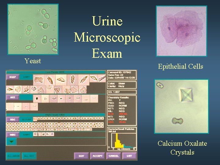 Yeast Urine Microscopic Exam Epithelial Cells Calcium Oxalate Crystals 