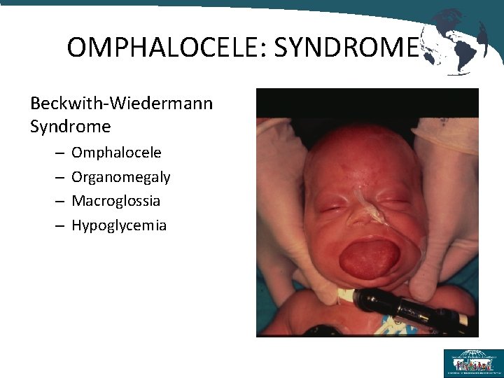 OMPHALOCELE: SYNDROME Beckwith-Wiedermann Syndrome – – Omphalocele Organomegaly Macroglossia Hypoglycemia 