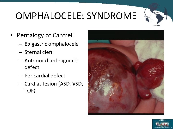 OMPHALOCELE: SYNDROME • Pentalogy of Cantrell – Epigastric omphalocele – Sternal cleft – Anterior