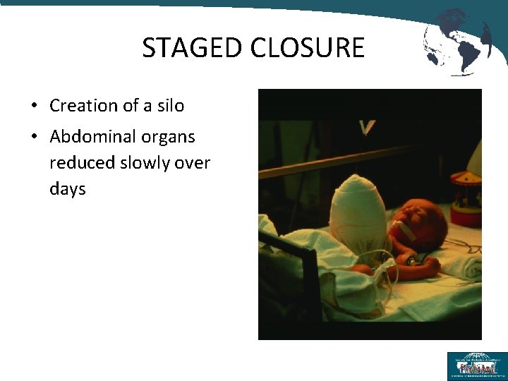 STAGED CLOSURE • Creation of a silo • Abdominal organs reduced slowly over days