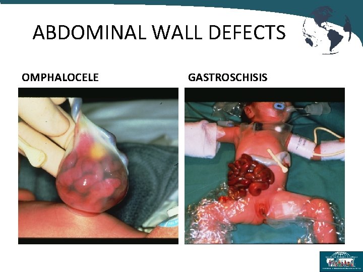 ABDOMINAL WALL DEFECTS OMPHALOCELE GASTROSCHISIS 