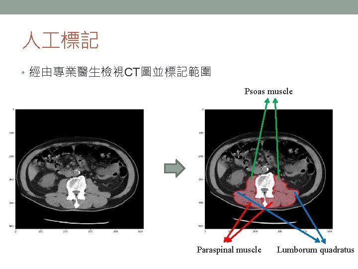 人 標記 • 經由專業醫生檢視CT圖並標記範圍 Psoas muscle Paraspinal muscle Lumborum quadratus 人 標記 • 經由專業醫生檢視CT圖並標記範圍 Psoas muscle Paraspinal muscle Lumborum quadratus