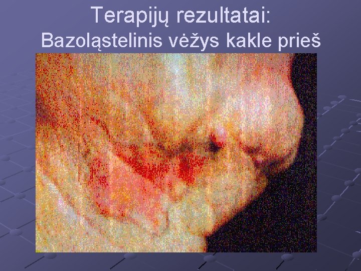 Terapijų rezultatai: Bazoląstelinis vėžys kakle prieš FNT 