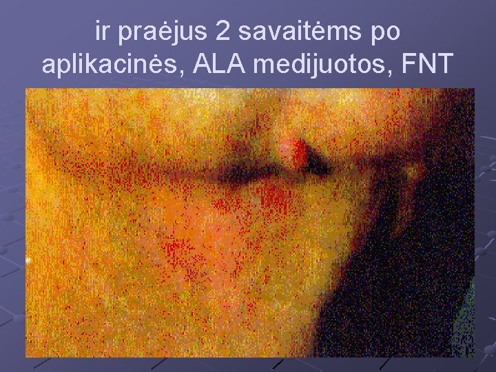 ir praėjus 2 savaitėms po aplikacinės, ALA medijuotos, FNT 