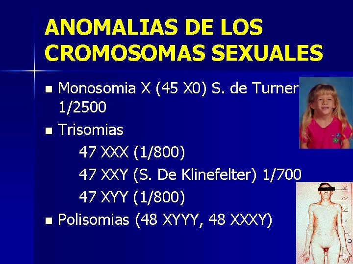 ANOMALIAS DE LOS CROMOSOMAS SEXUALES Monosomia X (45 X 0) S. de Turner 1/2500