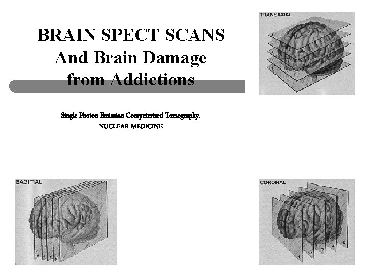 BRAIN SPECT SCANS And Brain Damage from Addictions Single Photon Emission Computerized Tomography. NUCLEAR