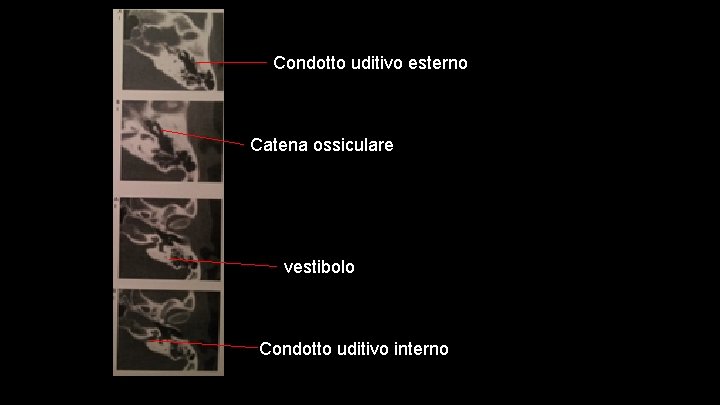 Condotto uditivo esterno Catena ossiculare vestibolo Condotto uditivo interno 