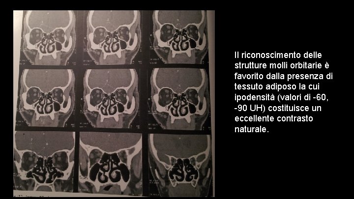 Il riconoscimento delle strutture molli orbitarie è favorito dalla presenza di tessuto adiposo la