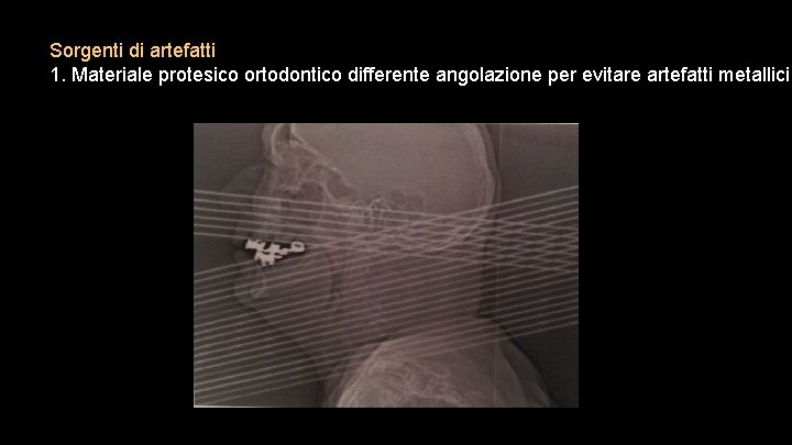 Sorgenti di artefatti 1. Materiale protesico ortodontico differente angolazione per evitare artefatti metallici 