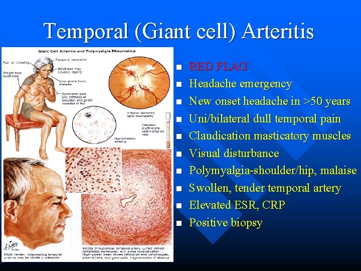 Temporal (Giant cell) Arteritis n n n n n RED FLAG Headache emergency New