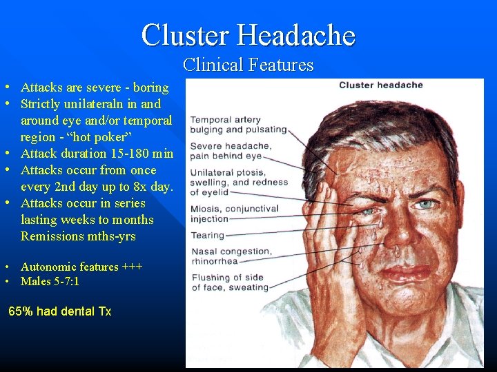 Cluster Headache Clinical Features • Attacks are severe - boring • Strictly unilateraln in