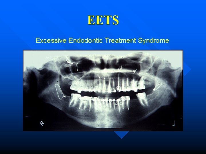 EETS Excessive Endodontic Treatment Syndrome 