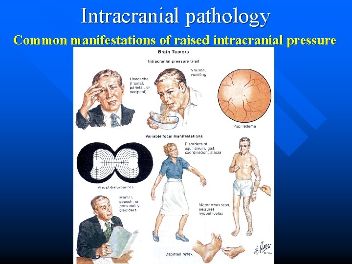 Intracranial pathology Common manifestations of raised intracranial pressure 