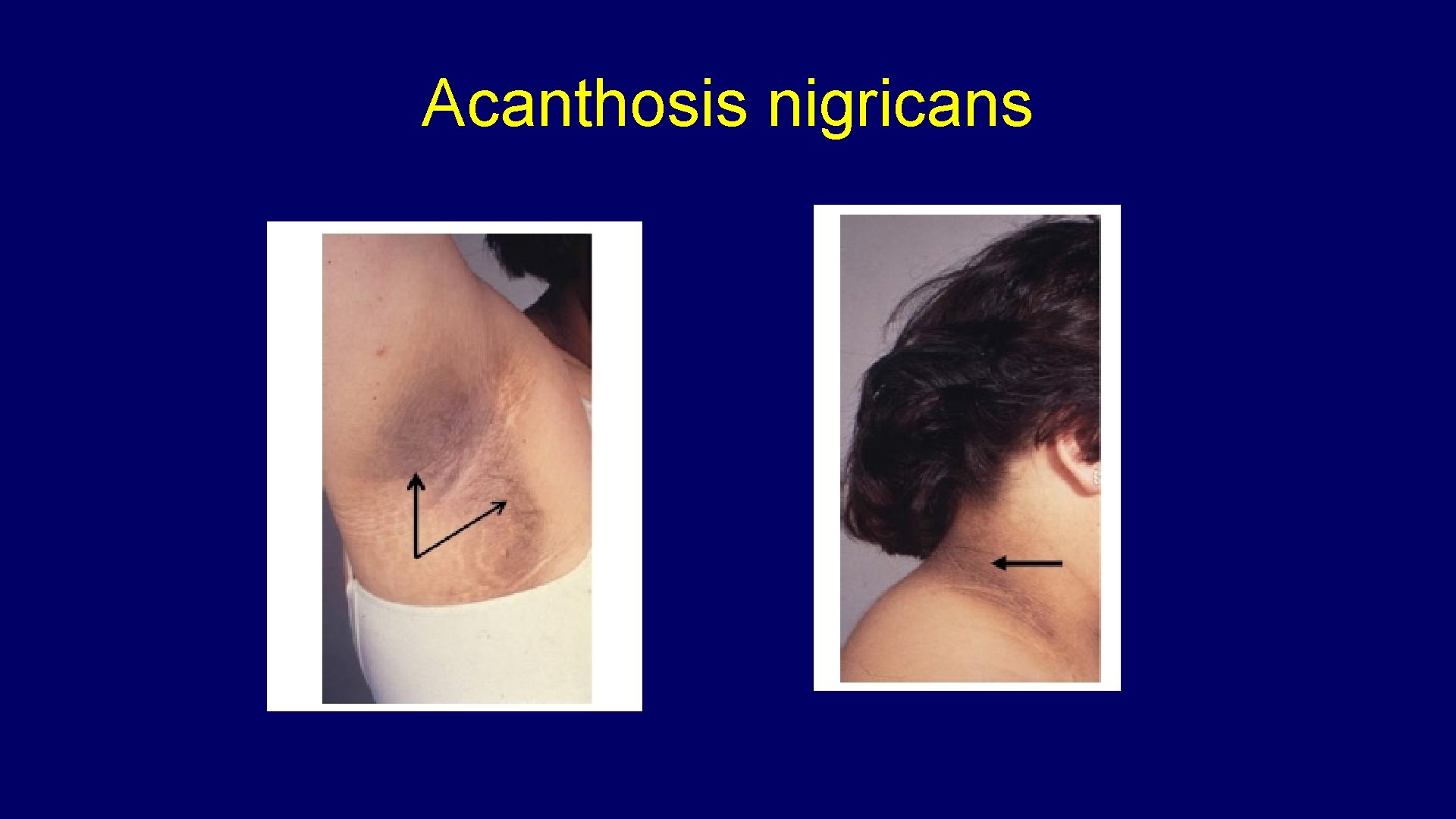 Acanthosis nigricans 