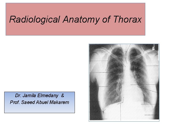 Radiological Anatomy Of Chest - The Radiology Assistant Basic