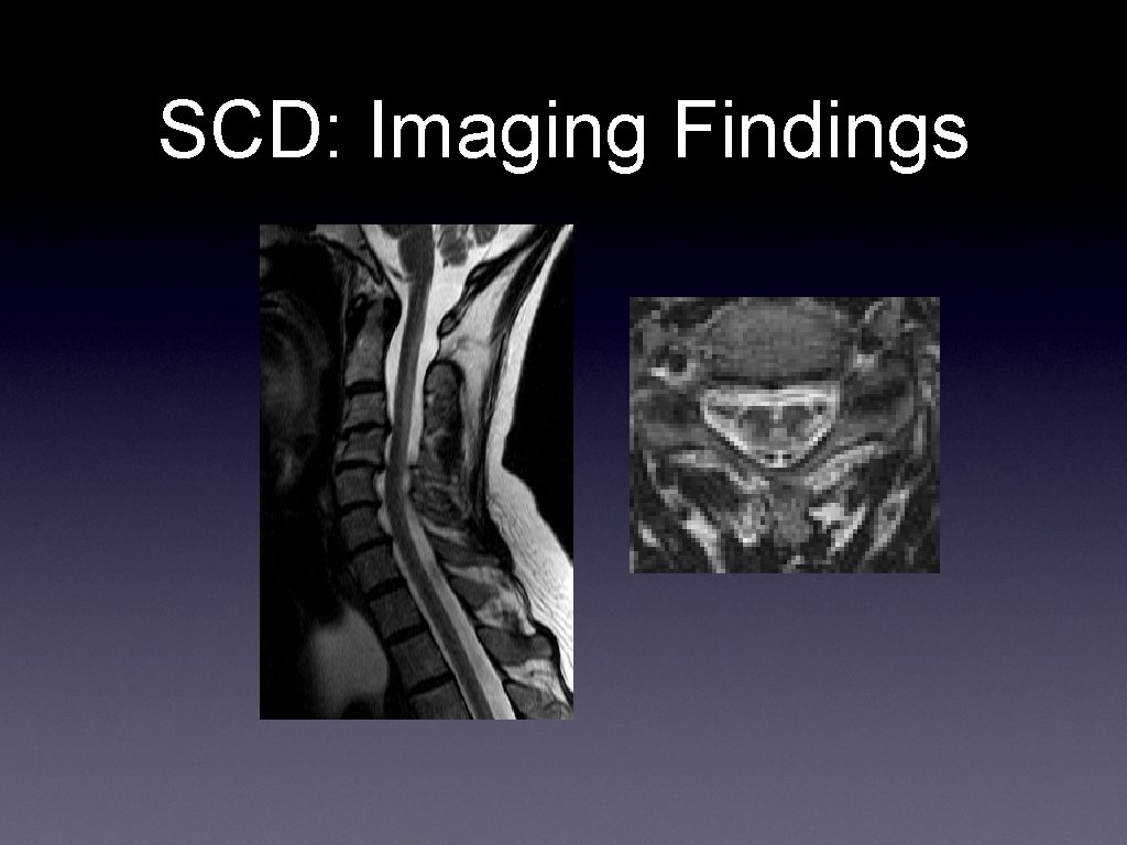 SCD: Imaging Findings 