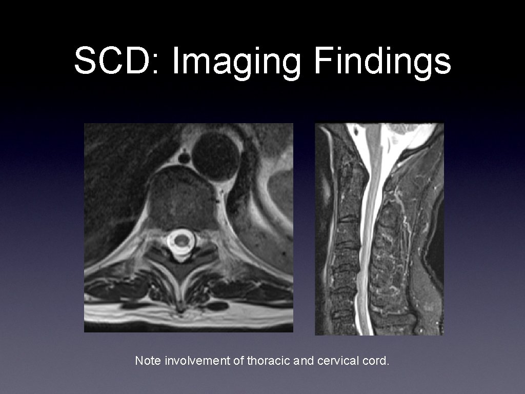 SCD: Imaging Findings Note involvement of thoracic and cervical cord. 