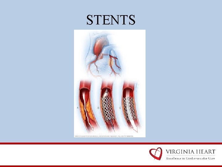 STENTS 