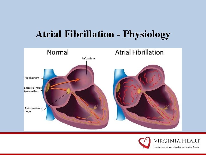 Atrial Fibrillation - Physiology 