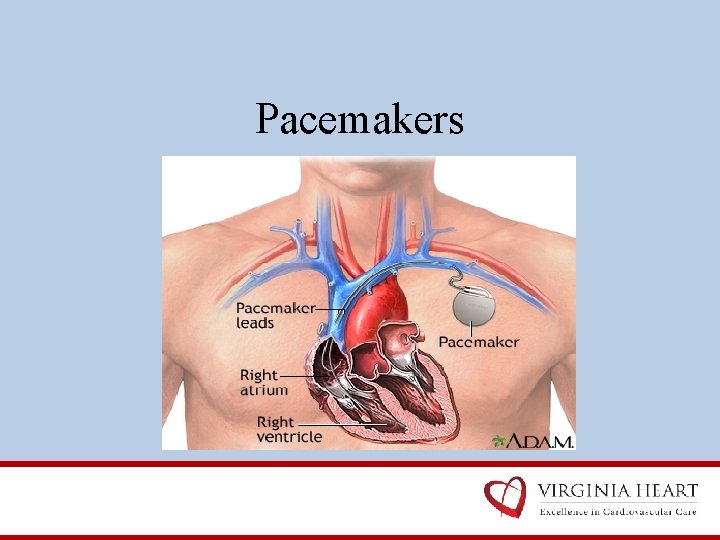 Pacemakers 