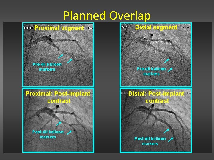 Planned Overlap Proximal segment Pre-dil balloon markers Proximal: Post-implant contrast Post-dil balloon markers Distal Planned Overlap Proximal segment Pre-dil balloon markers Proximal: Post-implant contrast Post-dil balloon markers Distal