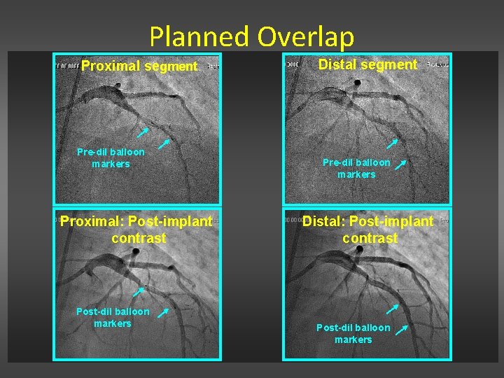 Planned Overlap Proximal segment Pre-dil balloon markers Proximal: Post-implant contrast Post-dil balloon markers Distal