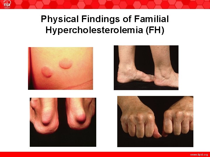 Physical Findings of Familial Hypercholesterolemia (FH) www. lipid. org 