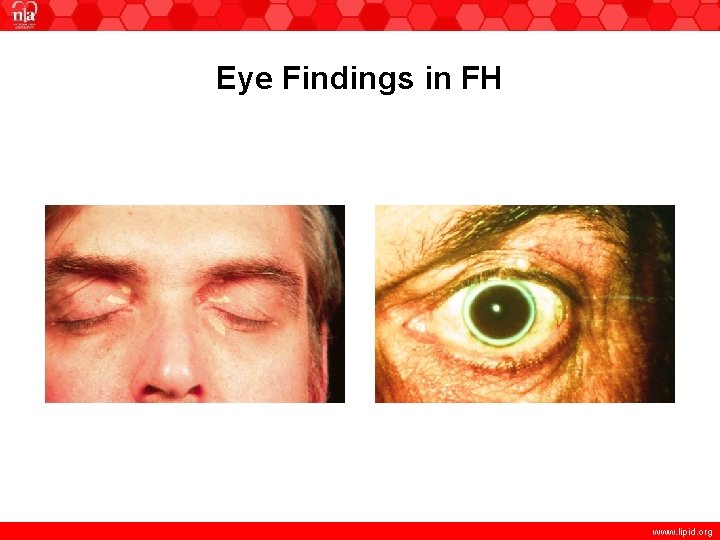 Eye Findings in FH www. lipid. org 