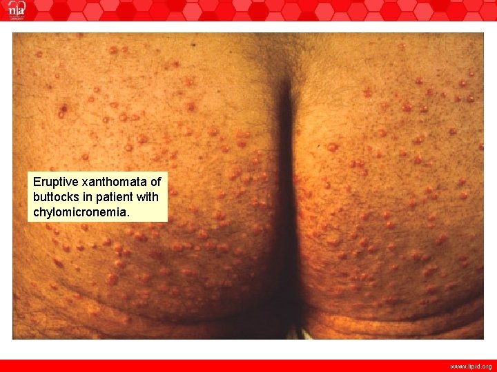 Eruptive xanthomata of buttocks in patient with chylomicronemia. www. lipid. org 