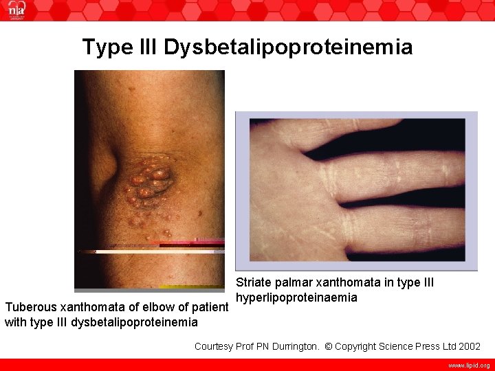 Type III Dysbetalipoproteinemia Tuberous xanthomata of elbow of patient with type III dysbetalipoproteinemia Striate
