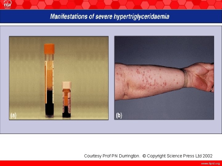 Courtesy Prof PN Durrington. © Copyright Science Press Ltd 2002 www. lipid. org 