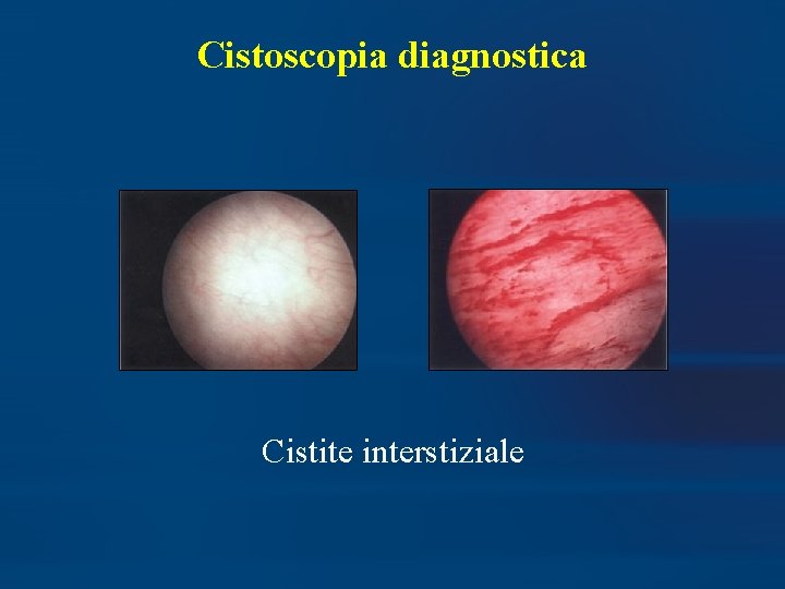 Cistoscopia diagnostica Cistite interstiziale 