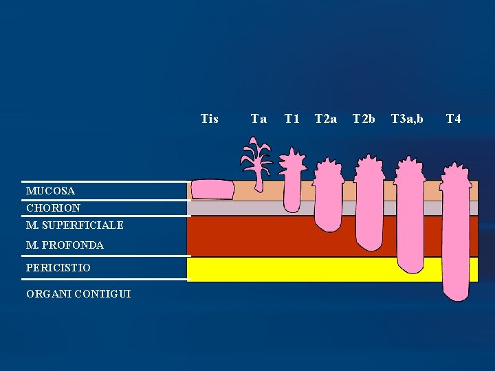 Tis MUCOSA CHORION M. SUPERFICIALE M. PROFONDA PERICISTIO ORGANI CONTIGUI Ta T 1 T