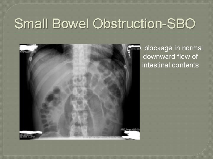 Small Bowel Obstruction-SBO A blockage in normal downward flow of intestinal contents Small Bowel Obstruction-SBO A blockage in normal downward flow of intestinal contents