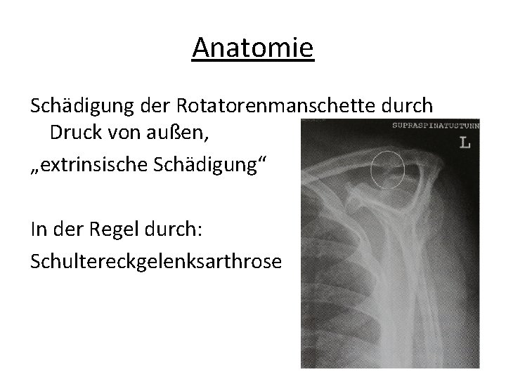 Anatomie Schädigung der Rotatorenmanschette durch Druck von außen, „extrinsische Schädigung“ In der Regel durch: