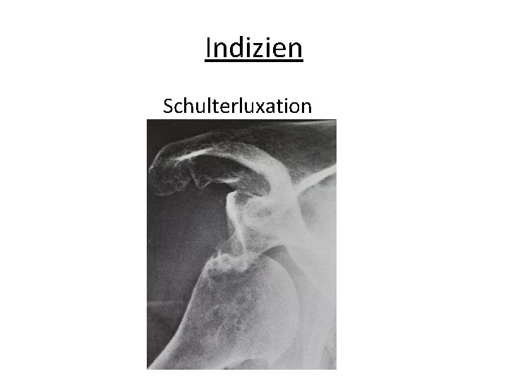 Indizien Schulterluxation 